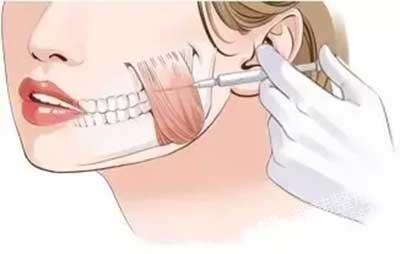 打一支瘦脸针多少钱,打瘦脸针要多少钱