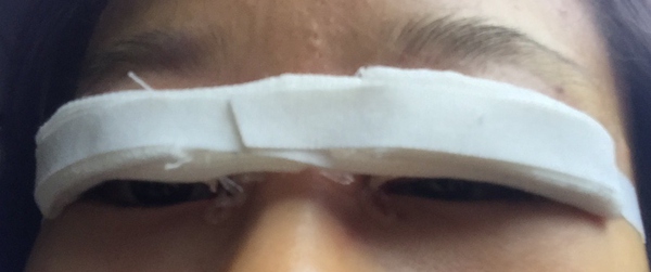 双眼皮手术第五天碰到水怎么办,双眼皮手术前感冒了怎么办