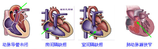 先天性心脏病常用的药物有哪些,十三味中药治疗心脏病