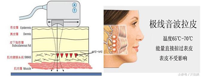 超声刀怎么样啊 (超声刀分享)