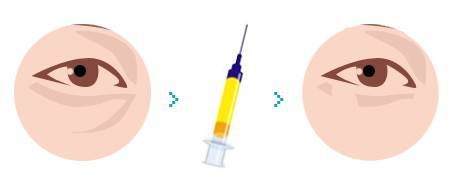 有泪沟怎么办最有效方法,有泪沟怎么办