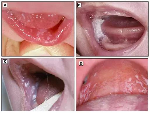 鹅鹅鹅鹅口疮，你需要知道这些