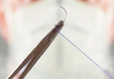 做埋线双眼皮以后不拆线可以吗,埋线双眼皮不拆线有危害吗