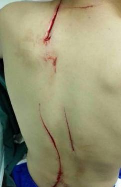 男孩疯狂自虐,浑身伤痕累累,一切都是为了妈妈