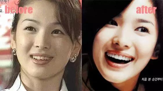 整牙=整容？看杨幂、刘涛、高圆圆为你亲身示范！