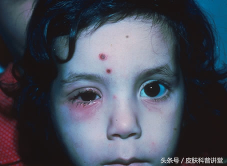 皮肤科疱疹,皮肤科一问一答