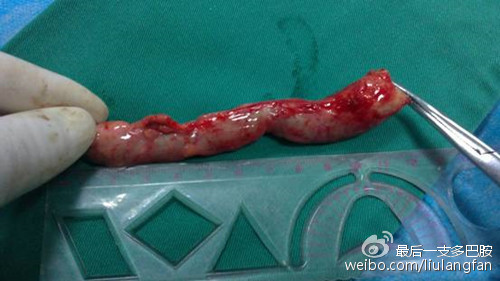 阑尾在哪个位置男左女右,阑尾的位置叫什么