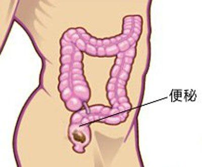 产后痔疮反复便血,产后痔疮便血有血块