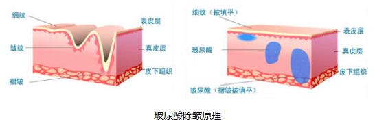 除皱选择点阵激光剥脱与非剥脱,一直做激光除皱会有副作用吗