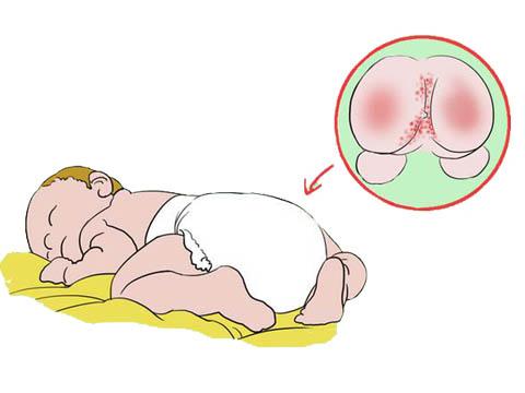 宝宝红屁股妈妈心疼哭了,宝宝屁股红疼如何快速解决问题