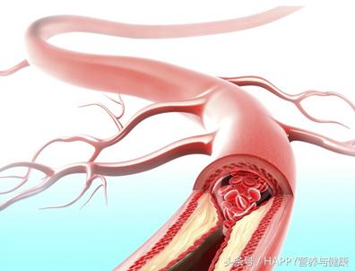 中风导致下肢血管堵塞,肢体肿胀是什么意思