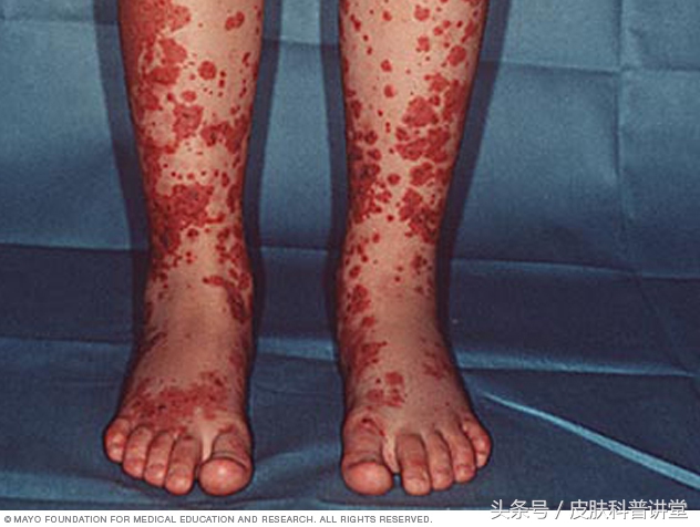 双小腿起红点不痛不痒是怎么回事,双小腿对称起红疹子痒是什么病
