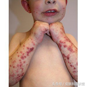 过敏性紫癜小腿胳膊有红点,过敏性紫癜一走路小腿就起红点