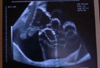 摸到明显胎动是不是羊水少,太早摸到胎动