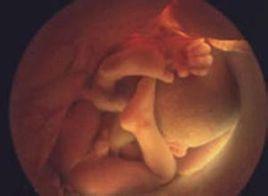 胎儿宫内窘迫是什么症,胎儿宫内窘迫症状