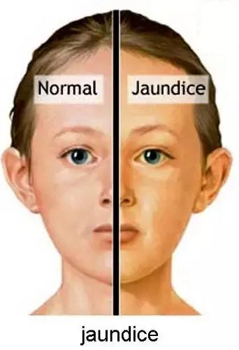 新生儿溶血性黄疸可怕吗,新生儿黄疸可怕不