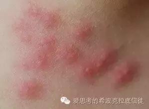 病毒狼疮,病毒引起的多形红斑狼疮