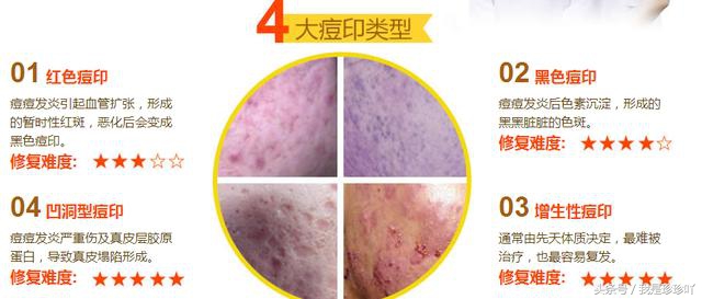 痘痘易祛,痘印长存!这样做才能拯救受损的痘印肌肤