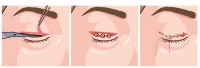 韩式三点定位双眼皮,韩式双眼皮三点定位设计