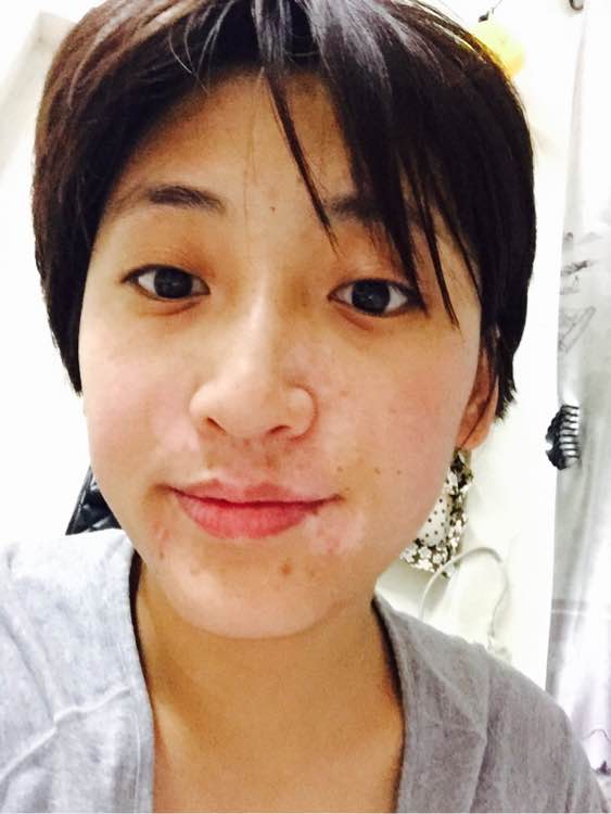 白斑光照,白斑光照后图片