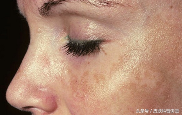 身上的褐斑慢慢长大了该怎么办,褐斑的原因及治疗方法