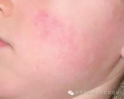 病毒狼疮,病毒引起的多形红斑狼疮