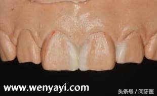 门牙有缝是什么说法,门牙有缝怎么办如何补救