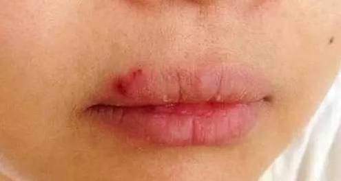 嘴唇上有几种颜色是什么病,嘴唇肿要警惕四种慢性病