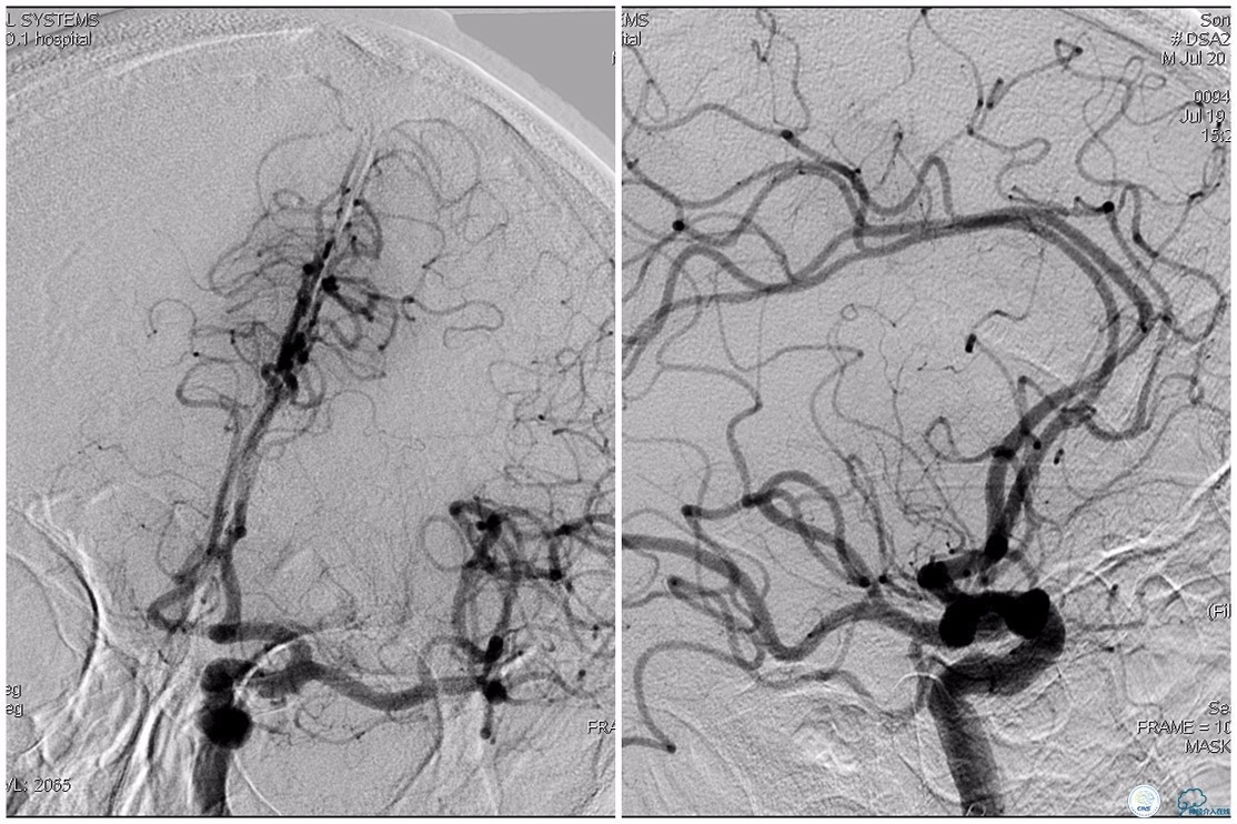 CINS2016病例展｜一例双侧大脑前动脉栓塞的再通治疗