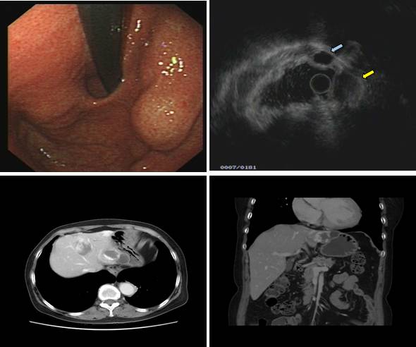 当EUS遇到“假瘤子”(二)——都是“隔壁老王”惹的祸(毗邻外压)
