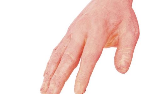手癣的好转迹象是什么,这三个症状可能是湿疹你都有吗