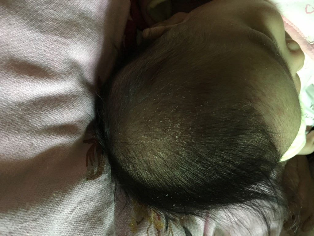 宝宝头上长很多污垢,宝宝头上污垢去除后又长多了
