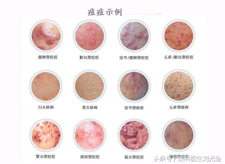 目前治疗痘痘的最佳方法,治疗痘痘最有效的医美方法