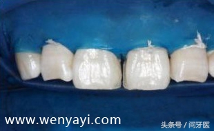 门牙有缝的女人有什么不好,门牙有缝怎么办