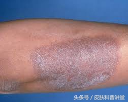 反复神经性皮炎是缺什么,神经性皮炎反反复复如何根除