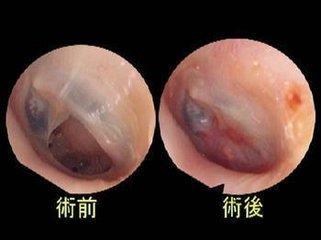 鼓膜穿刺术有后遗症吗,鼓膜穿刺术多少钱