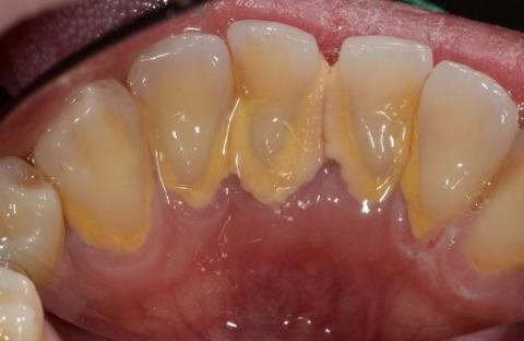 心脏旁边长了块石头有危险,身体长了石头吃什么最好