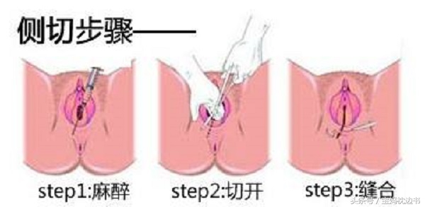 打算顺产的孕妈应该知道关于侧切的9个问题