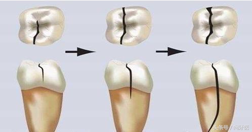 牙齿上有裂纹怎么办,牙齿上有裂纹怎么治