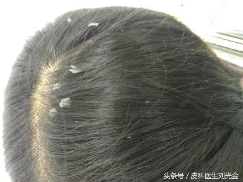 头皮屑多是不是缺少维生素b2,头皮屑多是不是皮肤病