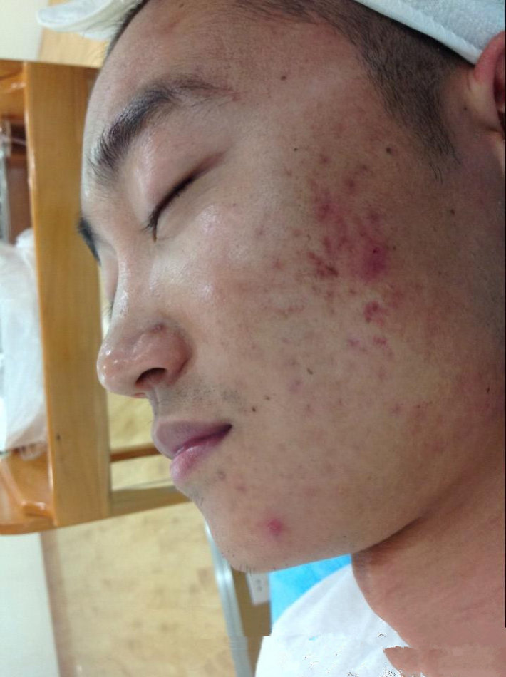 痘痘都是去哪里治好的,三角区长痘痘治疗的全部过程
