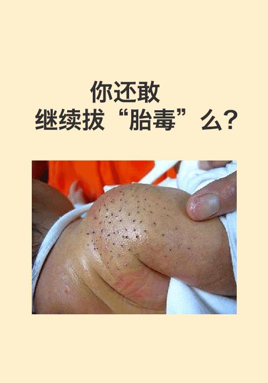 猪毛风在医学上叫什么病,新生儿的猪毛风是什么