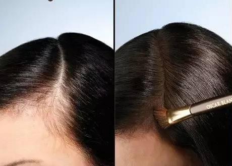 发际线过高怎么办,发际线太高怎么办如何降低发际线