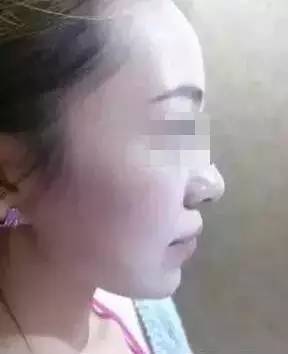 玻尿酸填充下巴一针还是两针好,玻尿酸丰下巴后要注意哪些问题