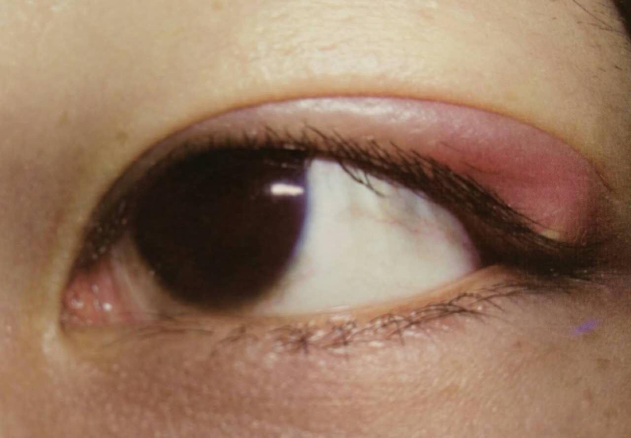 眼麦粒肿中医最快消除办法,中医治疗麦粒肿怎么治疗好得快