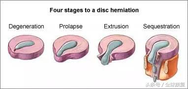 l45椎间盘突出的康复训练方法,c3-7椎间盘突出康复训练