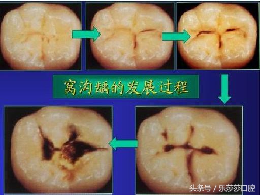 大牙上有黑线是怎么回事,孩子大牙上有黑线怎么办
