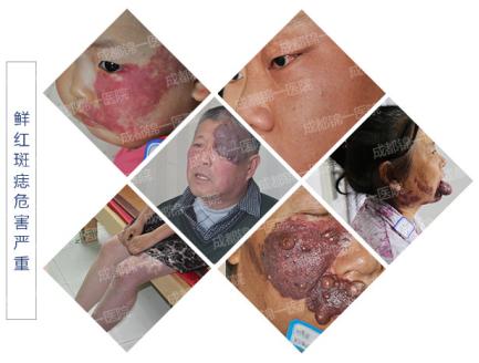 鲜红斑痣到底需不需要治疗？这个难题有答案了