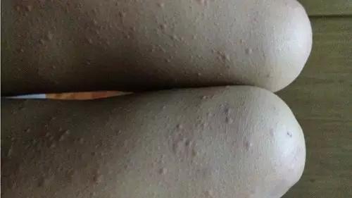 慢性荨麻疹怎么治疗能除根,慢性荨麻疹自愈的最佳方法