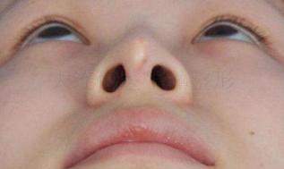 耳软骨隆鼻垫鼻尖缺点,隆鼻耳软骨垫鼻尖发白